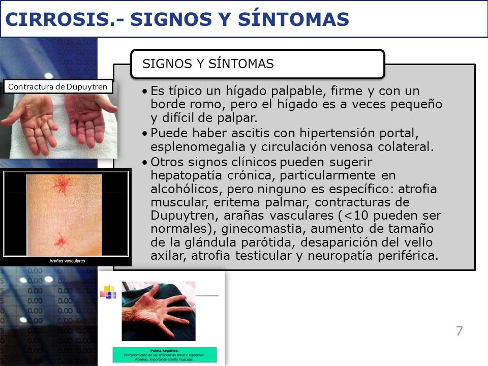 Hepatica avanzada sintomas de cirrosis